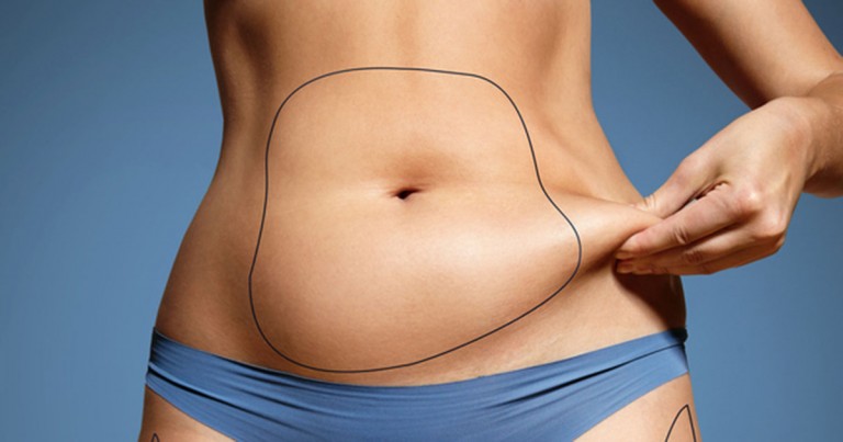 Le CoolSculpting : une solution miracle?