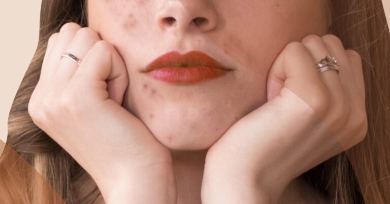 31 ans & acnéique : comment je gère et traite ma peau